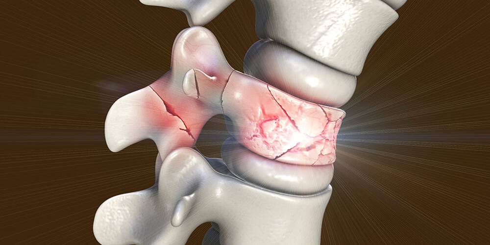 Beklemek mi Müdahale Etmek mi Omurgada Doğru Zamanı Nasıl Anlarsınız?